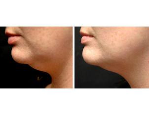 Double chin inch loss
