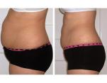 Stomach inch loss