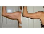 Arms inch loss